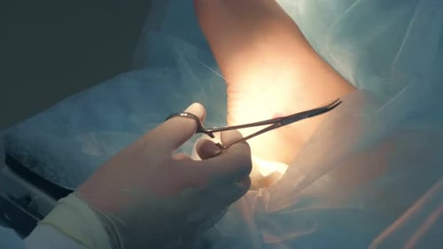 Chirurg vernäht den Knöchel während der Operation mit sauberen Stichen nach dem Entfernen des Hygroms