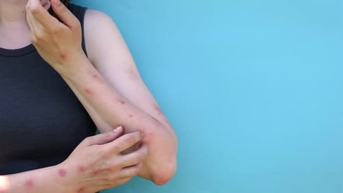 Woman Scratches Irritated Skin on Arm