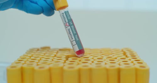 COVID-19 Positive Blood Test Sample in Test Tube