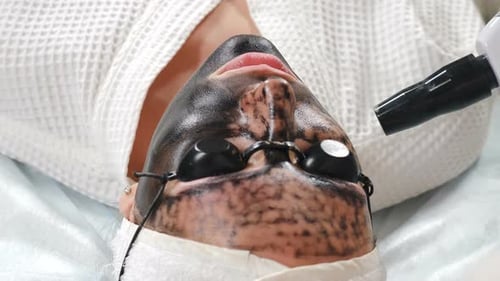 Woman Receiving Carbon Peel Facial Treatment
