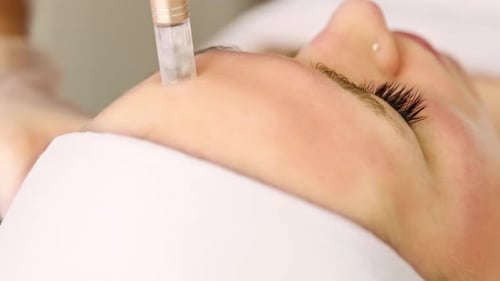 Beautician cosmetologist doing procedure fractional microneedle mesotherapy with Dermapen.