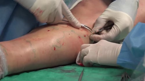 Surgical Procedure on Patient's Leg Close Up