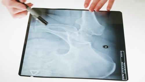 Primer plano de radiografía de cadera de pelvis