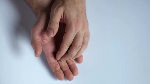 Close Up of Adult Hands With Red Spots