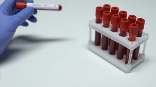 Gloved Hand Holds Positive Hepatitis A Test