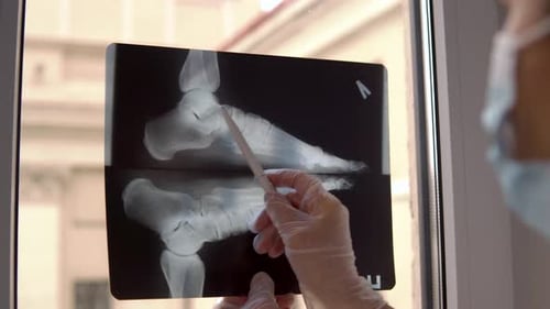 Arzt untersucht Röntgenfilm von gebrochenem Fuß