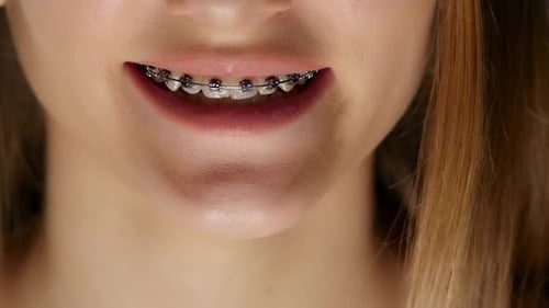 Braces. Black. Closeup