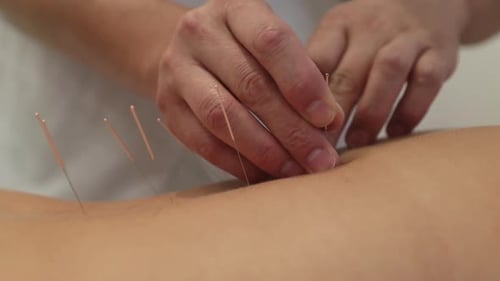 Tratamiento mediante acupuntura