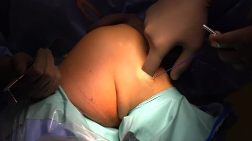 Close up of a Surgical Procedure in Hospital