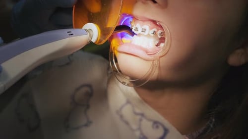 Orthodontist Shines on the Teeth with a Photopolymer Lamp