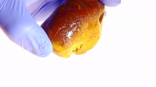 Medical Hands Rotating a Gallstone Close Up