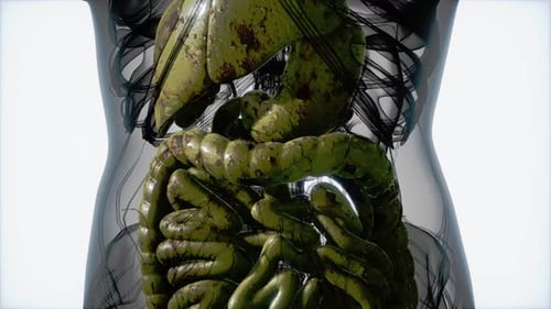 Diseased Human Digestive System Medical 3D Animation