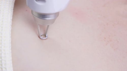 Laser Skin Rejuvenation Close-up. The Concept of Hardware Cosmetology