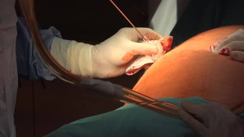 Liposuction And Belly Fat 5
