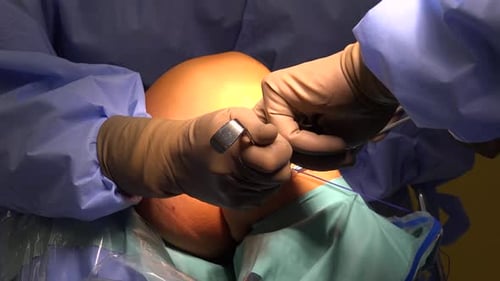 Surgeons Perform Knee Surgery Close Up