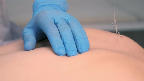 Hands Doctor Akupunkturist führt Akupunkturnadeln in den Rücken der Frau ein