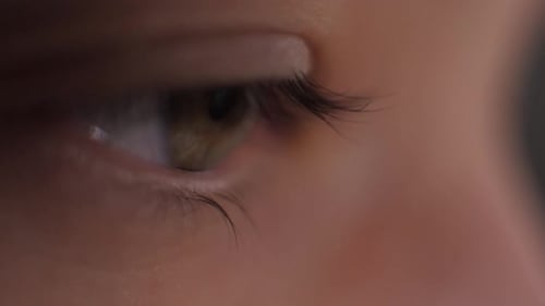 Krankes rotes menschliches Auge einer jungen Frau. Ein Mädchen nimmt ihre Brille ab und zeigt ein rotes Auge. Müde Augen