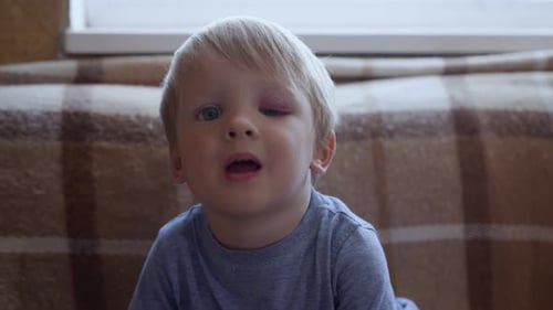 Childhood, Little Cute Child with Trauma on His Face and Black Eye Looks at Camera on Background of