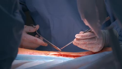 Surgeons Performing Operation in Hospital Operating Room