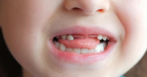 Sorriso de menina, dentes de bebê. Criança sacode a língua dente de leite.