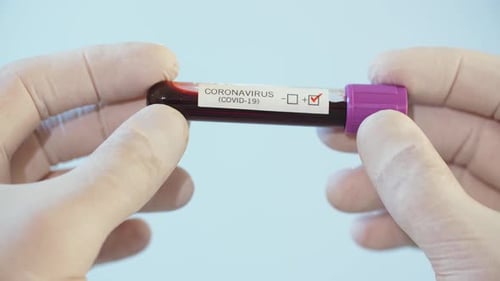 Positive Coronavirus Blood Test in Hospital Lab