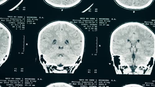 Brain Scan Imagery, Medical Diagnostic Technology