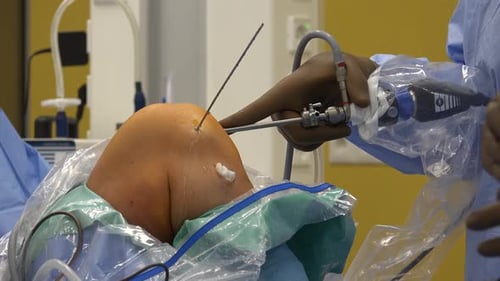 Arthroscopic Knee Surgery Procedure Close Up