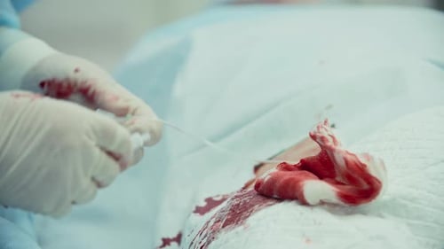 Bypass Chirurgie