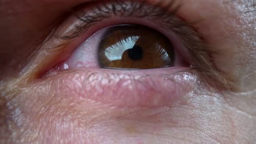 Extreme Nahaufnahmen mit roten Weißen nach Schlaflosigkeit Lange Arbeit am Computer