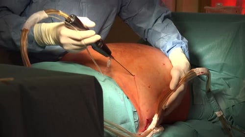 Liposuction And Belly Fat 14
