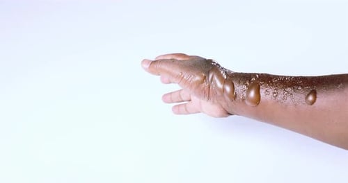 Arm and Hand with Multiple Blisters Close Up