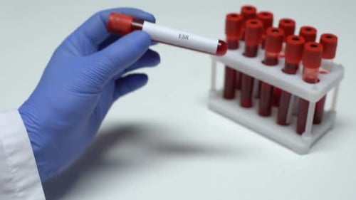 Prueba de ESR, médico mostrando muestra de sangre en tubo, investigación de laboratorio, chequeo de salud