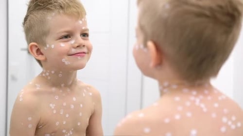 Child Smiles in Mirror with Spots on Skin