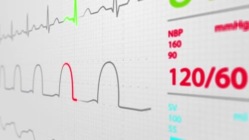 Animation of Intensive Care Unit monitor showing normal values for vital signs.