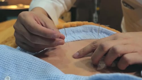 Mano del médico que realiza la terapia de acupuntura. Medicina alternativa: el médico clava agujas en el