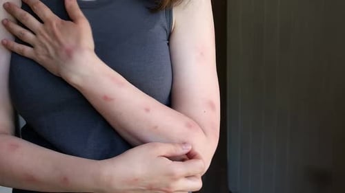 Woman with Red Rash on Arms Scratches