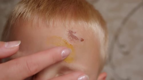 Applying Cream to a Wound on a Child