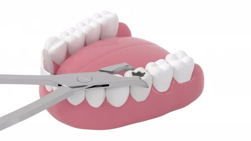 3D Animated Decayed Tooth Extraction