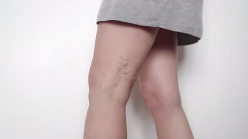 Primer plano de las piernas de una mujer con venas varicosas