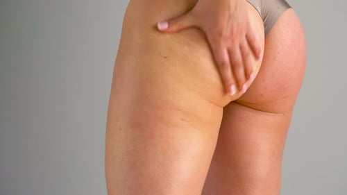 Woman Rubs Into the Skin of the Buttocks and Legs Anticellulite Cream