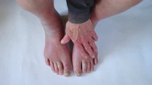 Nahaufnahme eines Fußes mit beschädigten Nägeln wegen eines Pilzes