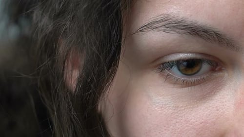 Girl With Swollen Eyelid Lowering Her Eyes, Problems With Health, Overwork