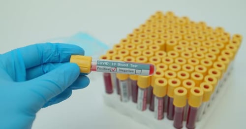 COVID Positive Blood Test in Laboratory Setting