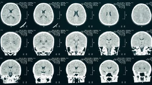 Radiology scan with brain cross section images