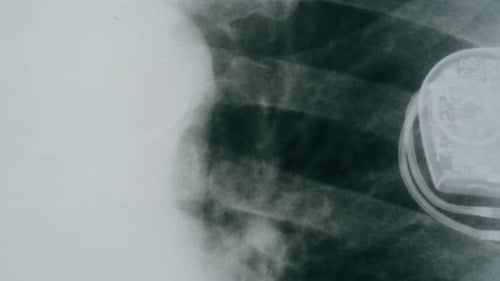 X-Ray Showing Rib Cage with a Pacemaker