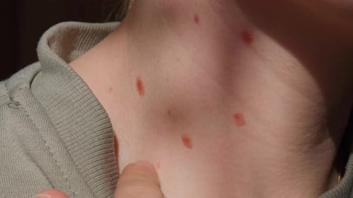 Birthmarks on Skin Close Up Detail of the Bare Skin Sun Exposure Effect on Skin Health Effects of UV