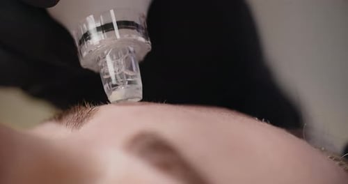 Cosmetic Procedure on Forehead Close Up