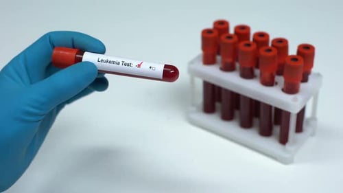 Positive Leukemia Blood Test in the Laboratory
