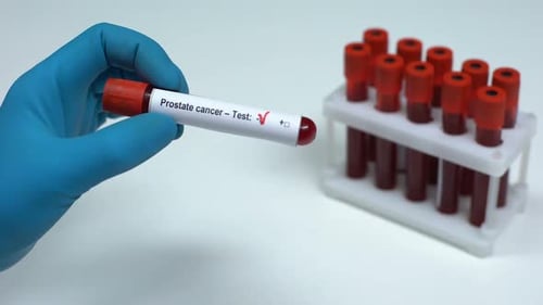 Cáncer de próstata negativo, médico que muestra una muestra de sangre, investigación de laboratorio, atención médica
