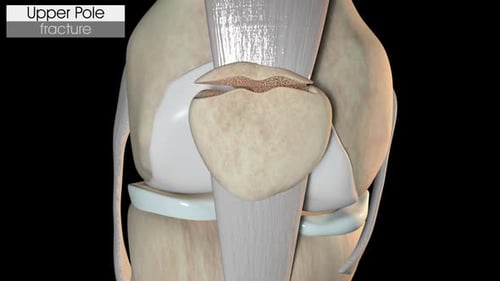 Fractura de rótula superior